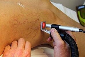 Krampfadern Behandlungsmethoden