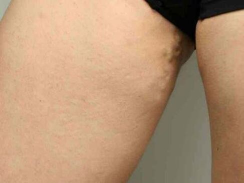 Krampfadern des Beckens während der Schwangerschaft