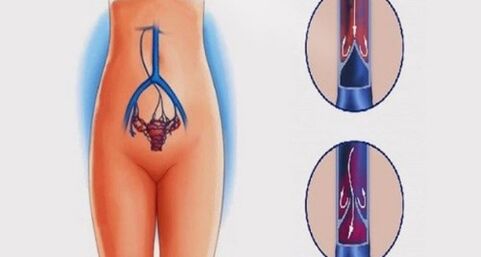 Anatomie der weiblichen Geschlechtsorgane und Venen, die von Krampfadern im Becken betroffen sind.